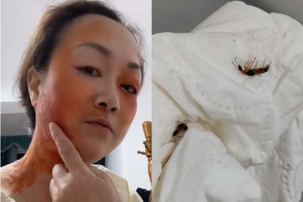 Many people in Henan, Hebei, and Shandong provinces are injured by the venom of hidden-wing insects.
